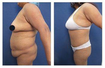 HD Lipo 360 Body Contouring