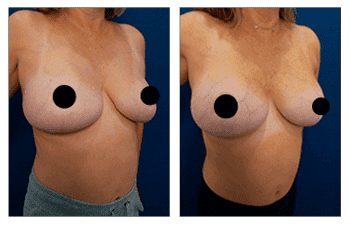 Breast Implant Augmentation After Breast Lift
