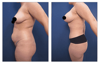 Breast Lift with Implants Near Me