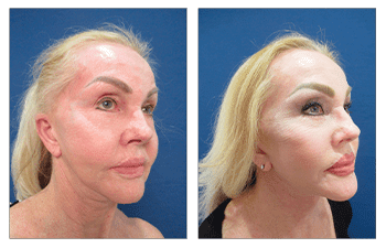 A woman's face before and after liposuction.