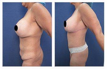 Mommy Makeover With Tummy Tuck And Breast Lift