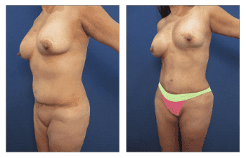 Best tummy tuck revision