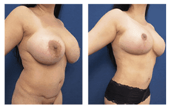 Liposuction Before and After Photos