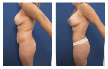 Liposuction in Newport Beach