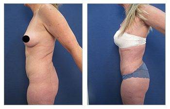 Mini Tummy Tuck Before and After Photo Gallery, Los Angeles, CA