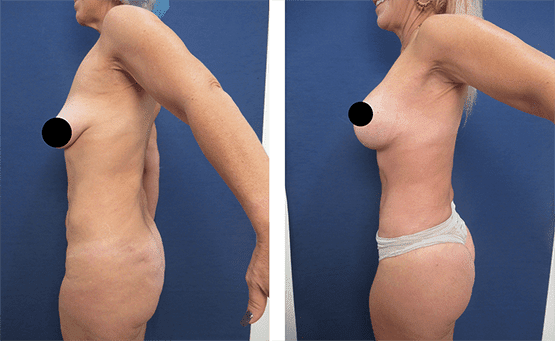 Mommy Makeover To Improve Belly Button Position