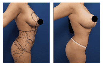 Buttock Augmentation Risks