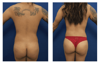 Brazilian Butt Lift for Palm Desert & Palm Springs