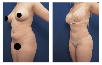 Liposuction Beverly Hills, Cosmetic Surgery