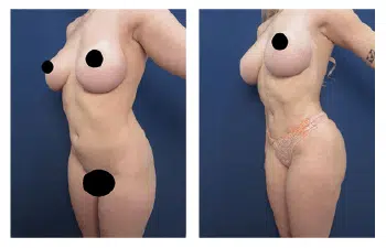 Most Expensive Liposuction in the World