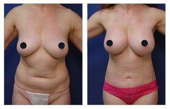 Mini Tummy Tuck Cost