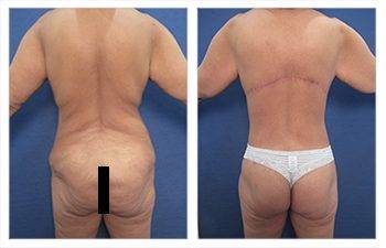 Mommy Makeover With Tummy Tuck And Breast Lift