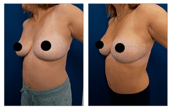 Breast Implant Augmentation After Breast Lift
