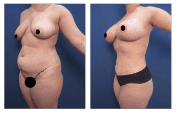 Breast Lift with Implants Near Me