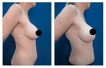 What is a Breast Lift with Implants Over the Muscle?