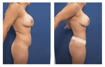 Liposuction in Newport Beach