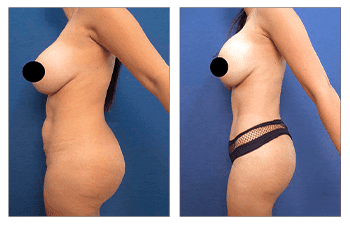 Avoid dog ears following tummy tuck