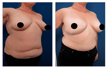 Bilateral Breast Mastectomy and Reconstruction Provides Improved Cosmetic Results