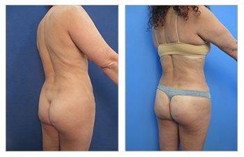 360 Liposuction