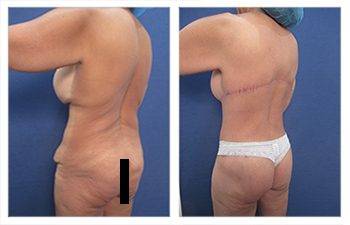 Mommy Makeover With Tummy Tuck And Breast Lift