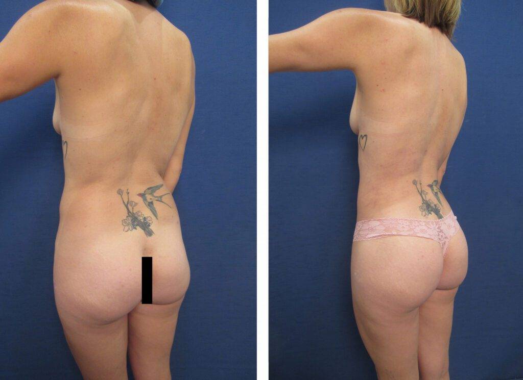 Brazilian Buttock Lift Revision Before And After