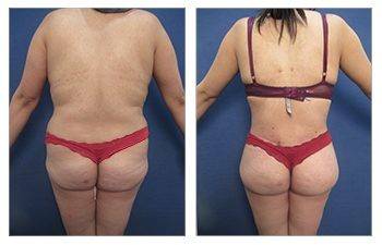 Buttock Implants BBL Plastic Surgery Cost Beverly Hills CA