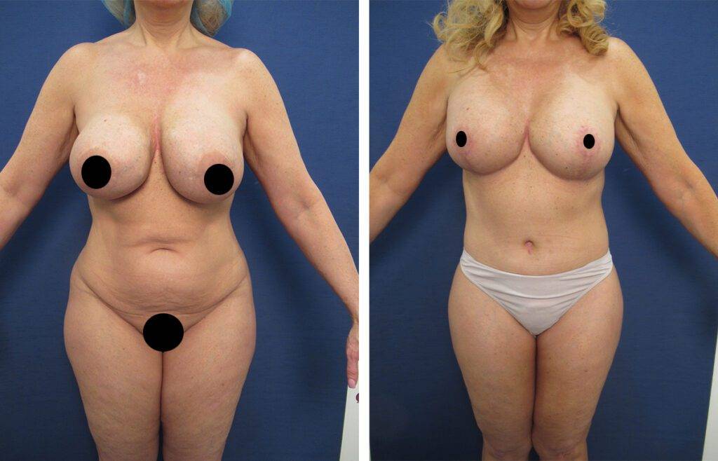 Mommy Makeover To Eliminate Flank Fullness