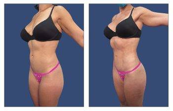 Mini Tummy Tuck Scar