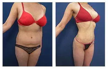 A woman in a bikini showcasing the remarkable before and after results of High Definition Liposuction.