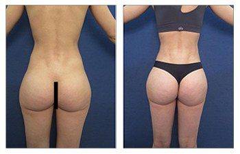 Nordesthetics clinic - BBL (Brazilian buttock lift surgery) is a  combination of liposuction and fat transfer to buttocks. At first, the fat  is taken from a certain body area (abdomen, back, thighs