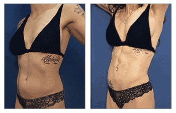 abdominal-etching-before-after-hd-vaser-lipo