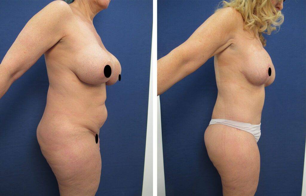 Mommy Makeover To Eliminate Flank Fullness