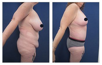How To Get Rid Of FUPA: Experts' Advice, Diet, Exercise, And Surgery