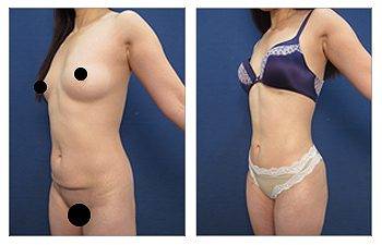 Mini Tummy Tuck Before and After