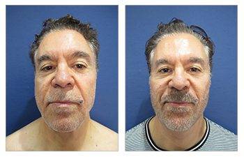 male facelift surgery