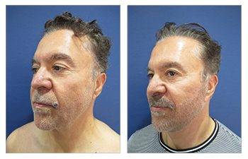 male facelift surgery