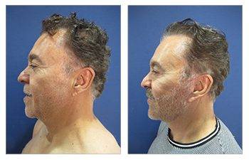 male facelift surgery