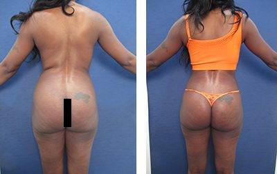 Best Liposuction Revision