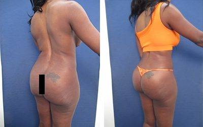 Tummy Tuck with liposuction of the flanks and iliac crest