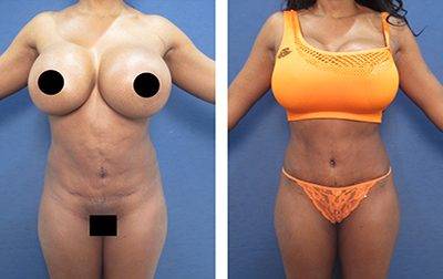 Tummy Tuck with liposuction of the flanks and iliac crest