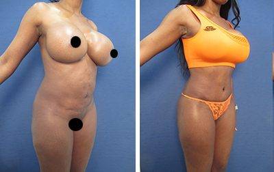 Body Contouring Before & After Photos - Orange County - Dr. Laguna