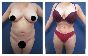 Y do you need compression garment after Vaser Liposuction?