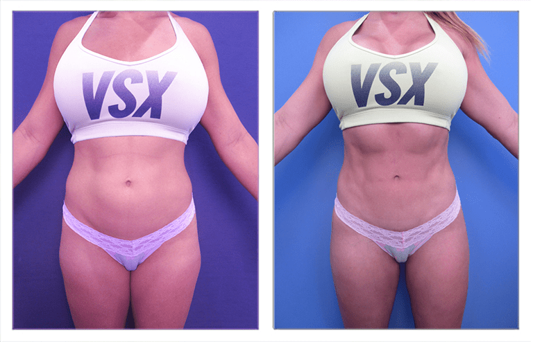 Affordable Liposuction Near Me? It's Possible! - Mid-Atlantic Skin