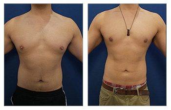 HOW TO PERFORM THE GYNECOMASTIA PINCH TEST - amandeephospital