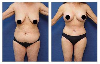 Decreasing Girth With Tummy Tuck