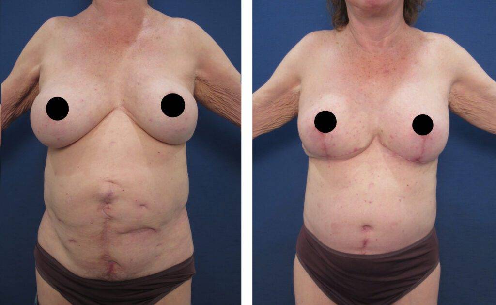 Eliminating A Bulging Belly With A Tummy Tuck