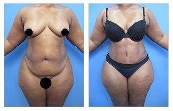 360 Liposuction, SurgiSculpt