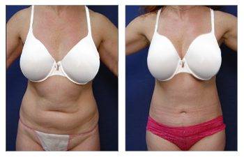 Tummy Tuck Alternatives