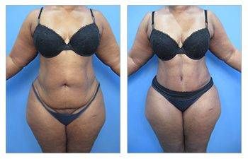 360 Liposuction, SurgiSculpt