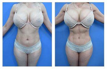 AirSculpt® Up A Cup Breast Augmentation